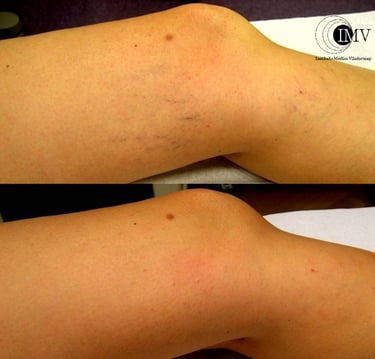 Tratamiento Varículas, Antes y después, Cambrils, Tarragona, Instituto Médico Vilafortuny,