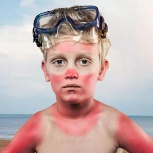 Dealing with Sunburns
