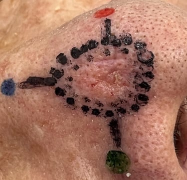 Marcação do tumor, Cirugia Micrográfica de Mohs em Salvador, Bahia