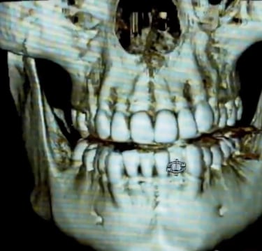 una imagen de los huesos maxilares en 3d