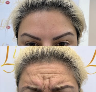 botox Escazu, San Jose Costa Rica