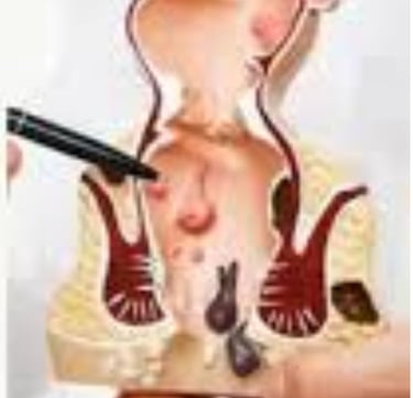 FAQs : Natural Remedies for Anal Fissures and Fistulas: Start with Honey and Fasting
