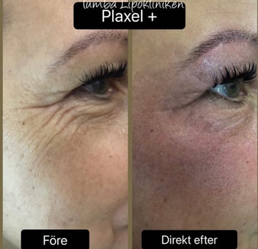 a person before and after plaxel plus