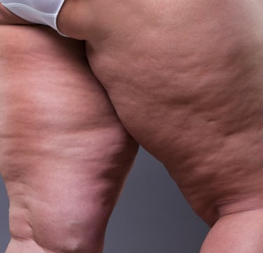 femme grosse cellulite obese