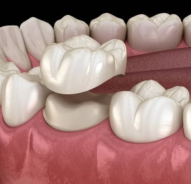 implante dentário