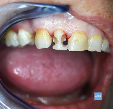 reconstruccion dental. clinica dental ades badajoz