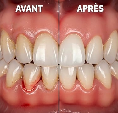 Curetage dentaire avant et après