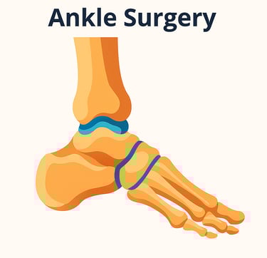 Ankle surgery repair physiotherapy