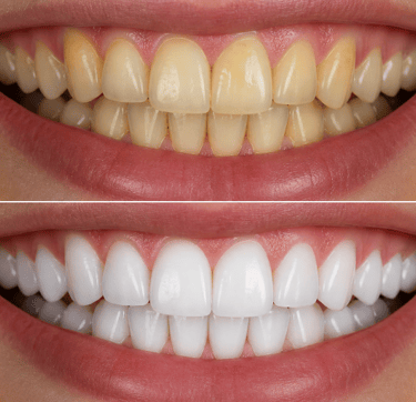 Bleaching Türkei İzmir — professionelle Zahnaufhellung bei Designed Smiles