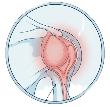 Bursites e Tendinites