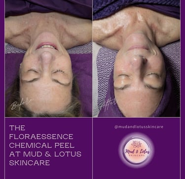 chemical peel at mud and lotus skincare in burnsville nc