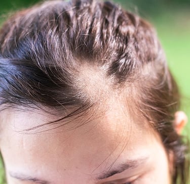 A professional psychiatrist in Vadodara offering effective treatment for hair pulling disorder (trichotillomania)