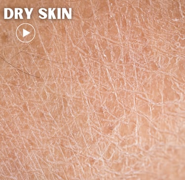 dry skin