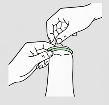 2 hands putting condom on with foreskin