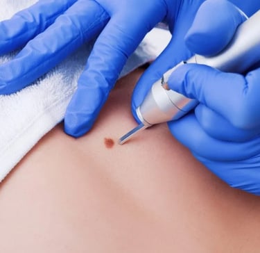 Dermatologist performing professional laser mole removal procedure on a patient's skin.