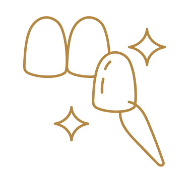 desenho de uma faceta dental em resina e porcelanato em são Mateus do Sul