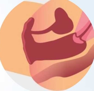 фото Схема збільшеної піхви