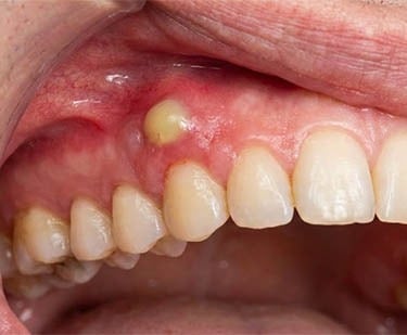 Photo abcès dentaire hygiene-precision.com