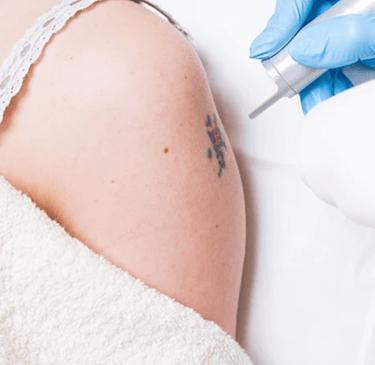 eliminación de tatuajes medianos