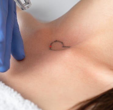 eliminación de tatuajes pequeños