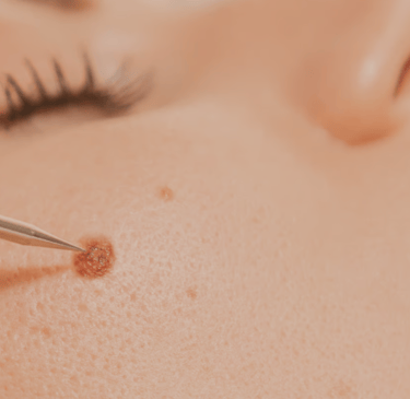 eliminación de lunares