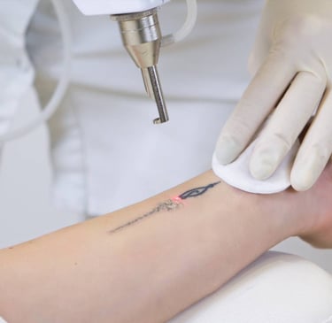 eliminación de tatuajes grandes