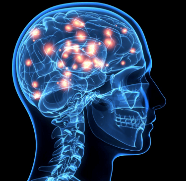 Digital image showing an X ray type image of a human head showing areas of light in the brain