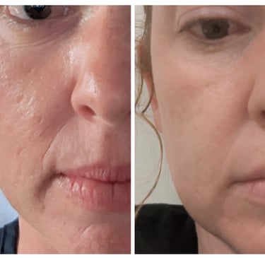 Before and after image of skin treated with mesotherapy and skin needling, salmon DNA.