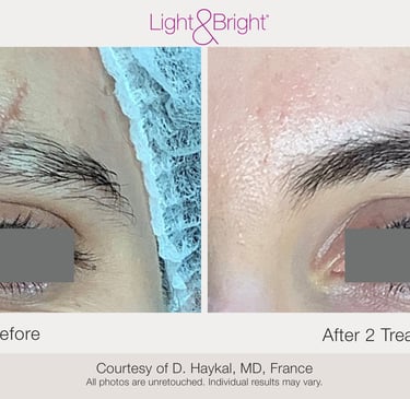 before and after acne scar and stretch mark treatment results in Hamilton
