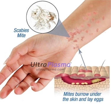 ultraplasma.com_Sarcoptes_scabiei_Infestation_Treatment_ultra_plasma_ultra_plazma