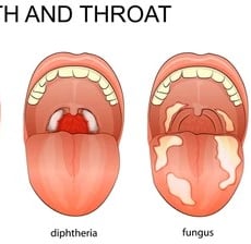 Understanding Diphtheria