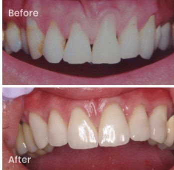 before and after picture of gum grafting