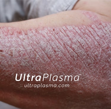 ultraplasma.com ultra plasma ultra plazma psoriasis sedef treatment tedavi