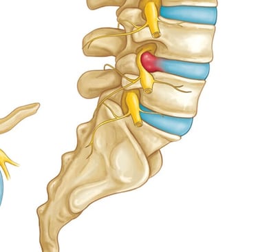 hernia de disco, hernia discal, dor na coluna, ciático