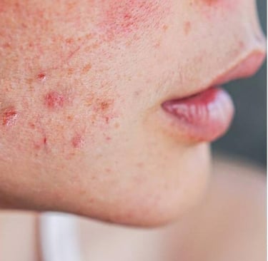 Señales de Hígado Graso en la Piel: Lo que tu Cuerpo te Está Diciendo