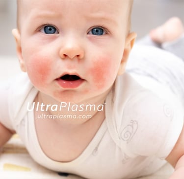 atopic_dermatitis_atopic_dermatit_egzama_eczemaultra_plasma_ultra_plazma_ultra-plasma_ultra-plazma