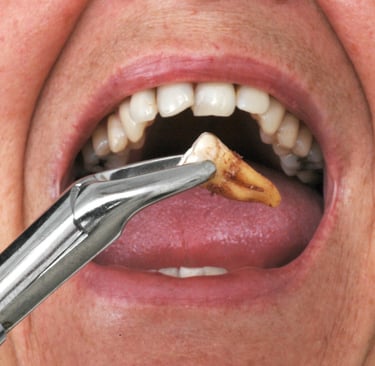 زراعة الأسنان - عيادة طب الاسنان دكتور وسام علي العباسي