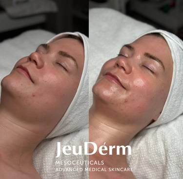 Before and After Luxpeel from Jeudérm
