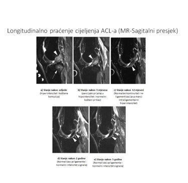 MR prikaz cijeljenja ACL-a kod neoperativne rehabilitacije