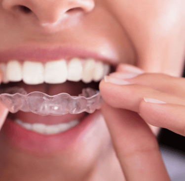 image of patient putting their invisalign in their mouth