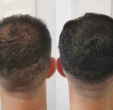 Avant et après : cicatrices FUE atténuées et cuir chevelu densifié.