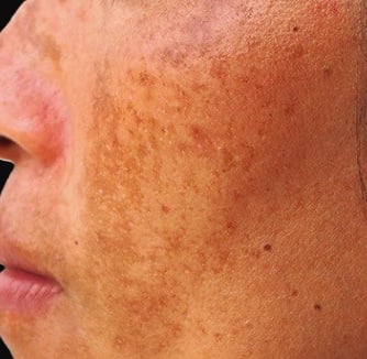 Melasma in a young girl