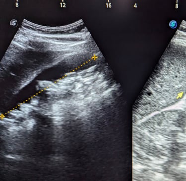 Ecografía abdominal de vesícula biliar con cálculos también conocida como litiasis vesicular