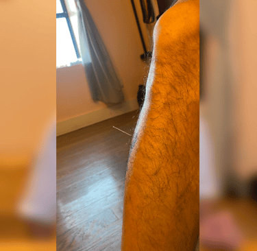 a pic showing an acupuncture needle in the shin muscle of the author, point name Stomach 36