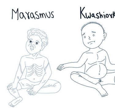 Marasmus