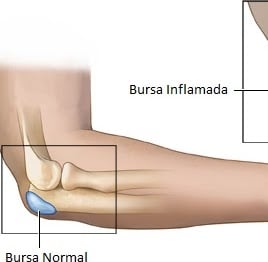 bursite, dor da bursa, bursa, dor articulação