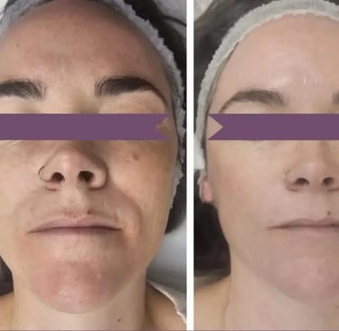 Peeling at Ariana Esthetic Edmonton