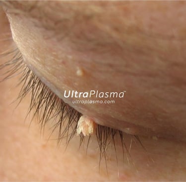 ultraplasma.com_wart_treatment_sigil_tedavisi_ultra_plasma_ultra_plazma
