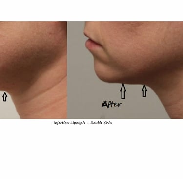 Fat reduction Delhi before and after photo – injection lipolysis double chin, male 20 yrs.