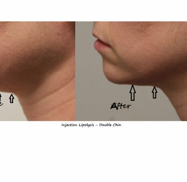 Fat reduction Delhi before and after photo – injection lipolysis double chin, male 20 yrs.
